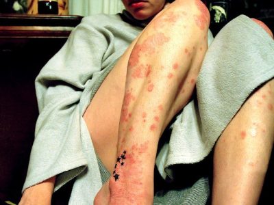 What Psoriasis is and How to Reduce It