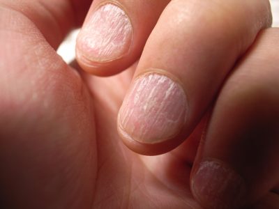 Health and Disease in Nails
