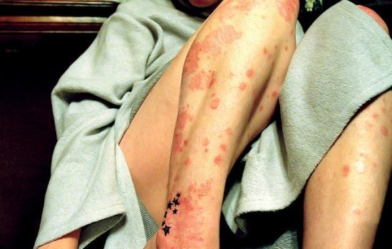 What Psoriasis is and How to Reduce It