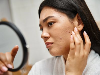 What Is Acne and Simple, Easy Ways to Get Rid of It