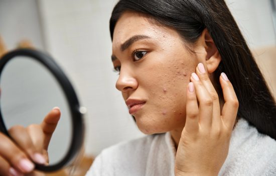 What Is Acne and Simple, Easy Ways to Get Rid of It
