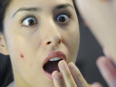 Simple and easy methods of getting rid of acne at home