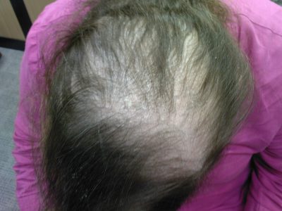 Severe hair loss in women