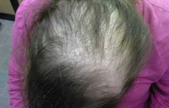Severe hair loss in women